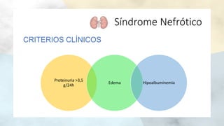 Síndrome Nefrótico
CRITERIOS CLÍNICOS
Proteinuria >3,5
g/24h
Edema Hipoalbuminemia
 
