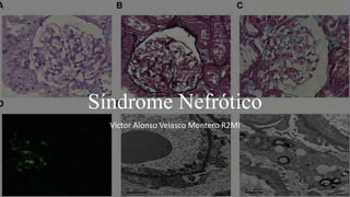 Síndrome Nefrótico
Victor Alonso Velasco Montero R2MI
 