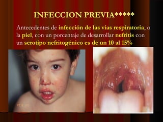 INFECCION PREVIA*****
Antecedentes de infección de las vías respiratoria, o
la piel, con un porcentaje de desarrollar nefritis con
un serotipo nefritogénico es de un 10 al 15%
 