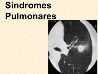 Síndromes
Pulmonares
 
