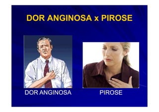 DOR ANGINOSA x PIROSE




DOR ANGINOSA   PIROSE
 