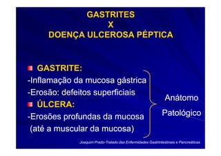 GASTRITES
                X
     DOENÇA ULCEROSA PÉPTICA


   GASTRITE:
-Inflamação da mucosa gástrica
-Erosão: defeitos superficiais
                                                              Anátomo
   ÚLCERA:
-Erosões profundas da mucosa                                Patológico
 (até a muscular da mucosa)
             Joaquim Prado-Tratado das Enfermidades Gastrintestinais e Pancreáticas
                     Prado-
 