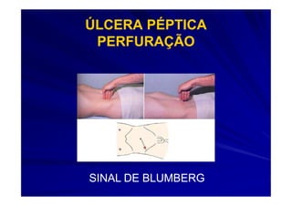 ÚLCERA PÉPTICA
 PERFURAÇÃO




SINAL DE BLUMBERG
 