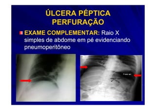 ÚLCERA PÉPTICA
        PERFURAÇÃO
EXAME COMPLEMENTAR: Raio X
simples de abdome em pé evidenciando
pneumoperitôneo
 