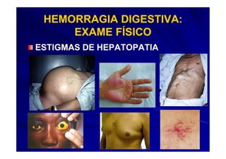 HEMORRAGIA DIGESTIVA:
     EXAME FÍSICO
ESTIGMAS DE HEPATOPATIA
 