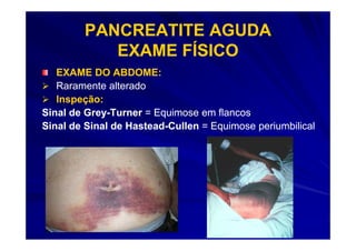 PANCREATITE AGUDA
           EXAME FÍSICO
   EXAME DO ABDOME:
   Raramente alterado
   Inspeção:
Sinal de Grey-Turner = Equimose em flancos
         Grey-
Sinal de Sinal de Hastead-Cullen = Equimose periumbilical
                  Hastead-
 
