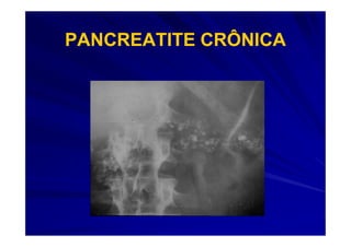PANCREATITE CRÔNICA
 