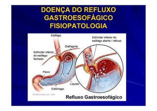 DOENÇA DO REFLUXO
 GASTROESOFÁGICO
  FISIOPATOLOGIA
 