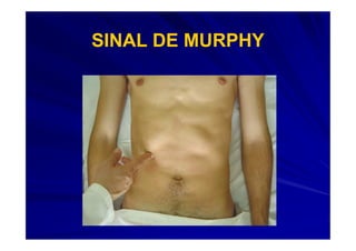 SINAL DE MURPHY
 