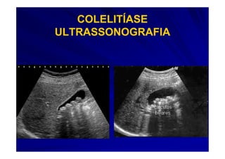 COLELITÍASE
ULTRASSONOGRAFIA
 