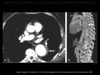 • Haaga JR, Dogra VS, Forsting M, et al. TC e RM uma abordagem do corpo humano completa. Editora Mosby-Elsevier, 2009 ..
• Haaga JR, Dogra VS, Forsting M, et al. TC e RM uma abordagem do corpo humano completa. Editora Mosby-Elsevier, 2009




                 Haaga JR, Dogra VS, Forsting M, et al. TC e RM uma abordagem do corpo humano completa. Editora Mosby-Elsevier, 2009.
 