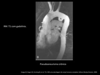 RM: T1 com gadolínio.




                                            Pseudoaneurisma crônico


                Haaga JR, Dogra VS, Forsting M, et al. TC e RM uma abordagem do corpo humano completa. Editora Mosby-Elsevier, 2009.
 