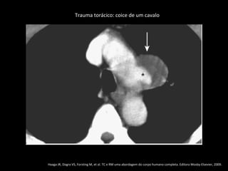 Trauma torácico: coice de um cavalo




Haaga JR, Dogra VS, Forsting M, et al. TC e RM uma abordagem do corpo humano completa. Editora Mosby-Elsevier, 2009.
 