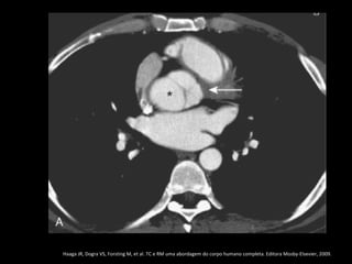 Haaga JR, Dogra VS, Forsting M, et al. TC e RM uma abordagem do corpo humano completa. Editora Mosby-Elsevier, 2009.
 