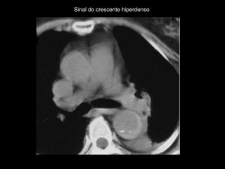 Sinal do crescente hiperdenso




                 http://emedicine.medscape.com/article/416776-overview#a20
 