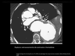 • Haaga JR, Dogra VS, Forsting M, et al. TC e RM uma abordagem do corpo humano completa. Editora Mosby-Elsevier, 2009 .




                    Ruptura: extravazamento do contraste e hemotórax


                       Haaga JR, Dogra VS, Forsting M, et al. TC e RM uma abordagem do corpo humano completa. Editora Mosby-Elsevier,
                       2009.
 