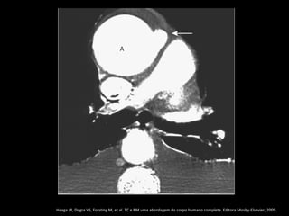 Haaga JR, Dogra VS, Forsting M, et al. TC e RM uma abordagem do corpo humano completa. Editora Mosby-Elsevier, 2009.
 