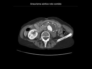 Aneurisma aórtico roto contido




                    http://emedicine.medscape.com/article/416397-overview
 