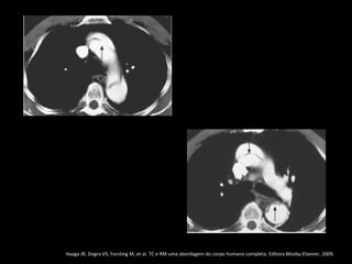 Haaga JR, Dogra VS, Forsting M, et al. TC e RM uma abordagem do corpo humano completa. Editora Mosby-Elsevier, 2009.
 