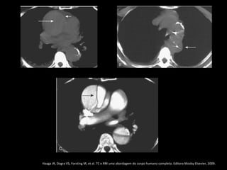Haaga JR, Dogra VS, Forsting M, et al. TC e RM uma abordagem do corpo humano completa. Editora Mosby-Elsevier, 2009.
 