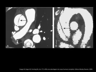Haaga JR, Dogra VS, Forsting M, et al. TC e RM uma abordagem do corpo humano completa. Editora Mosby-Elsevier, 2009.
 