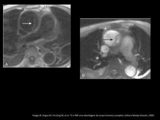 Haaga JR, Dogra VS, Forsting M, et al. TC e RM uma abordagem do corpo humano completa. Editora Mosby-Elsevier, 2009.
 