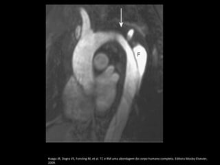 Haaga JR, Dogra VS, Forsting M, et al. TC e RM uma abordagem do corpo humano completa. Editora Mosby-Elsevier,
2009.
 