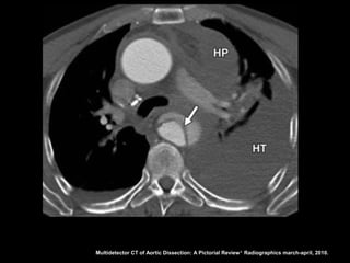 Multidetector CT of Aortic Dissection: A Pictorial Review 1. Radiographics march-april, 2010.
 