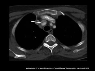 Multidetector CT of Aortic Dissection: A Pictorial Review 1. Radiographics march-april, 2010.
 