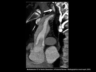 Multidetector CT of Aortic Dissection: A Pictorial Review 1. Radiographics march-april, 2010.
 