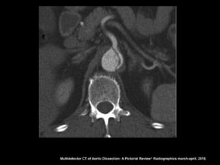 Multidetector CT of Aortic Dissection: A Pictorial Review 1. Radiographics march-april, 2010.
 