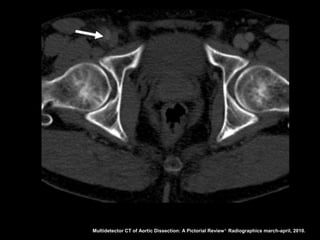 Multidetector CT of Aortic Dissection: A Pictorial Review 1. Radiographics march-april, 2010.
 