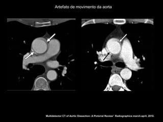 Artefato de movimento da aorta




Multidetector CT of Aortic Dissection: A Pictorial Review 1. Radiographics march-april, 2010.
 