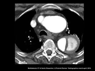 Multidetector CT of Aortic Dissection: A Pictorial Review 1. Radiographics march-april, 2010.
 