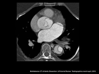 Multidetector CT of Aortic Dissection: A Pictorial Review 1. Radiographics march-april, 2010.
 