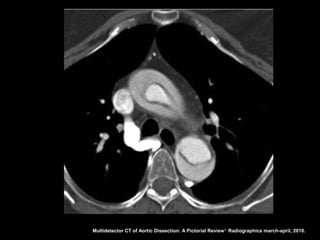 Multidetector CT of Aortic Dissection: A Pictorial Review 1. Radiographics march-april, 2010.
 