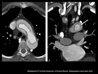 Multidetector CT of Aortic Dissection: A Pictorial Review 1. Radiographics march-april, 2010.
 