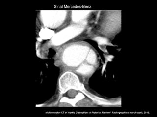 Sinal Mercedes-Benz




Multidetector CT of Aortic Dissection: A Pictorial Review 1. Radiographics march-april, 2010.
 