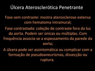 Úlcera Aterosclerótica Penetrante
 Fase sem contraste: mostra aterosclerose extensa
            com hematoma intramural;
 Fase contrastada: coleção de contraste fora da luz
   da aorta. Podem ser únicas ou múltiplas. Com
frequência associa-se a espessamento da parede da
                       aorta;
A úlcera pode ser assintomática ou complicar com a
   formação de pseudoaneurismas, dissecção ou
                      ruptura.
 