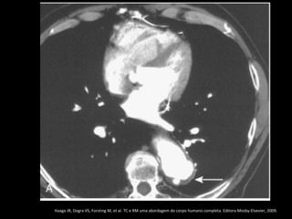 Haaga JR, Dogra VS, Forsting M, et al. TC e RM uma abordagem do corpo humano completa. Editora Mosby-Elsevier, 2009.
 