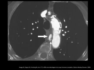 Haaga JR, Dogra VS, Forsting M, et al. TC e RM uma abordagem do corpo humano completa. Editora Mosby-Elsevier, 2009.
 