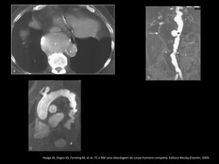 Haaga JR, Dogra VS, Forsting M, et al. TC e RM uma abordagem do corpo humano completa. Editora Mosby-Elsevier, 2009.
 