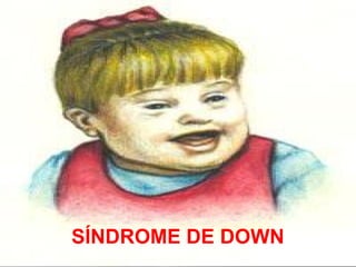 SÍNDROME DE DOWN
 
