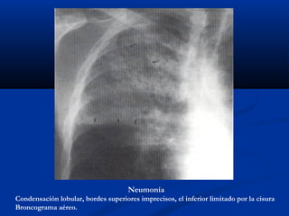 Neumonía
Condensación lobular, bordes superiores imprecisos, el inferior limitado por la cisura
Broncograma aéreo.
 