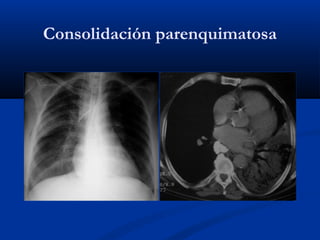 Consolidación parenquimatosa
 