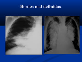 Bordes mal definidos
 