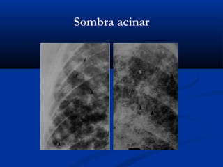 Sombra acinar
 