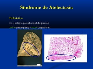 Definición:
Es el colapso parcial o total del pulmón
atele-vs (incompleto) y éktasis (expansión)
Síndrome de Atelectasia
 
