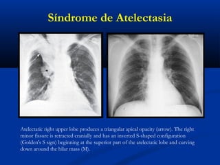 Síndrome de Atelectasia
Atelectatic right upper lobe produces a triangular apical opacity (arrow). The right
minor fissure is retracted cranially and has an inverted S-shaped configuration
(Golden's S sign) beginning at the superior part of the atelectatic lobe and curving
down around the hilar mass (M).
 