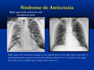 Síndrome de Atelectasia
Right upper lobe atelectasis leading to hazy opacification of the right upper lung field. A
juxtaphrenic peak is present (arrow); this finding indicates loss of volume in the upper
lobe and can be a helpful sign of upper lobe atelectasis.
Right upper lobe atelectasis with
juxtaphrenic peak
 